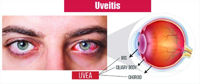 Clinical Pearls for Treating Uveitis